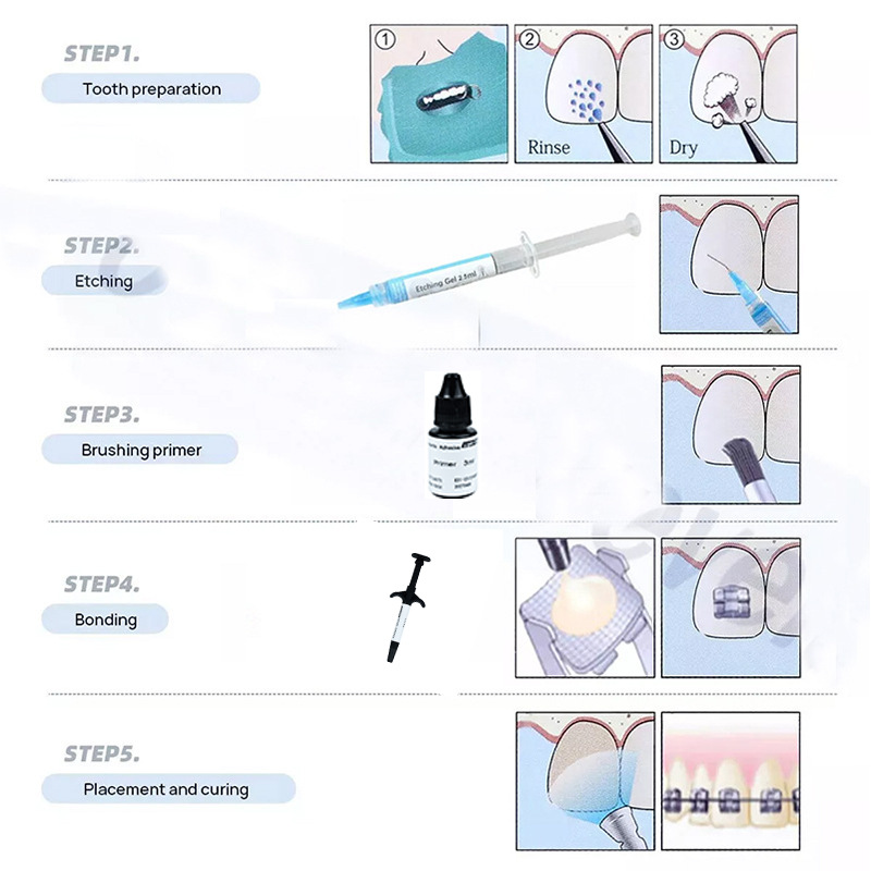 歯科用光硬化矯正用接着剤キット（ブラケット用ユニバーサル矯正 - Dental Impression Material Kit のレビューと価格